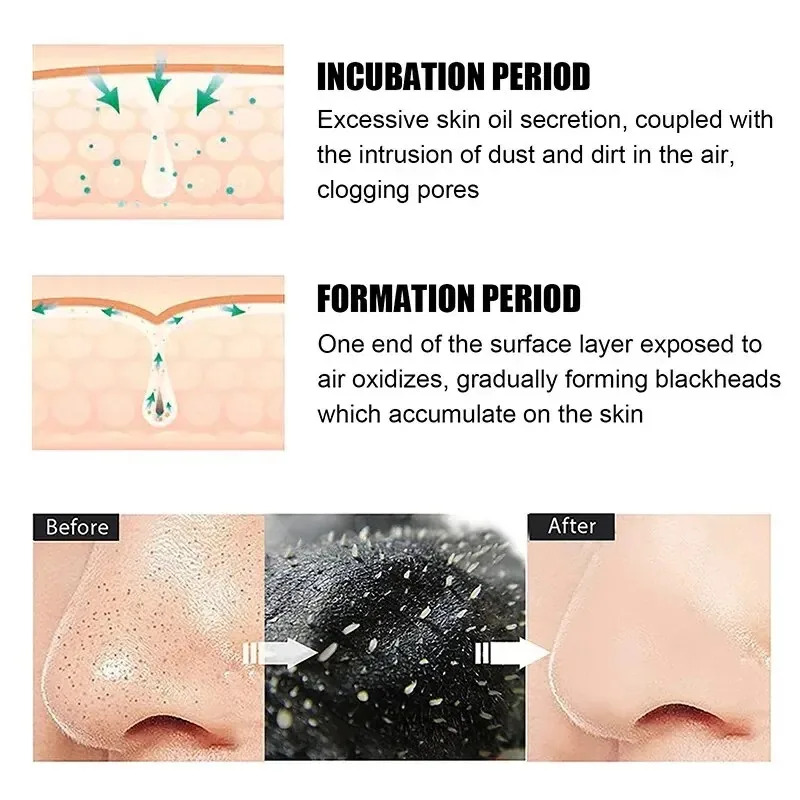 10/150PCS Blackhead Remove Mas - Skincare Finally Found You 评论和价格